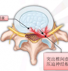 微创手术治疗腰椎间盘突出症
